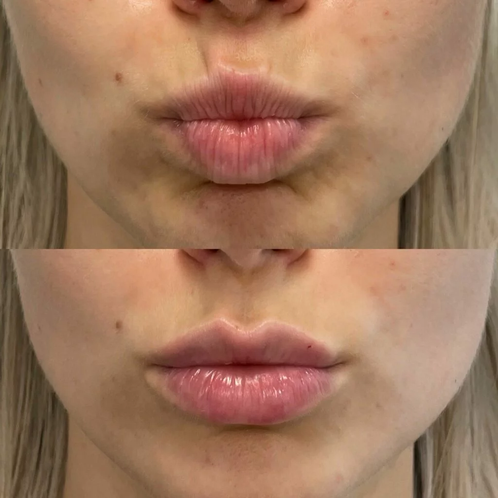 Insights on Botox Lip Flipping by Dr